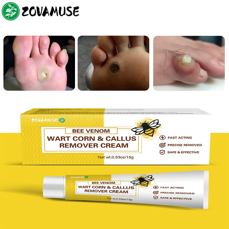 Corn Softening Cream for Thick, Hardened Skin