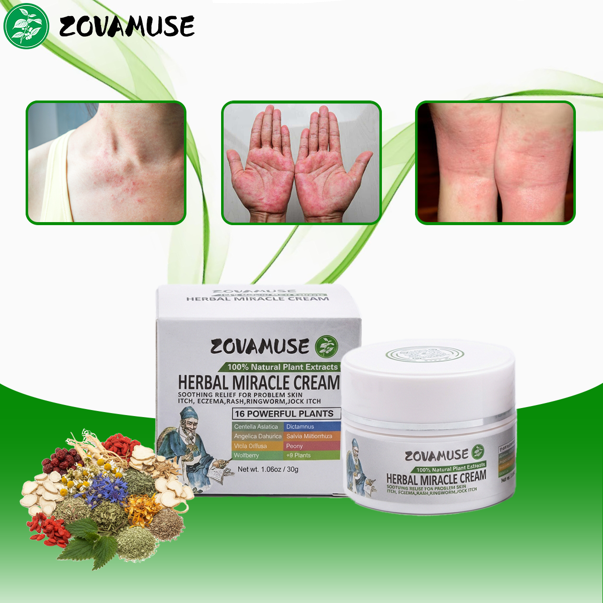 Herbal Miracle Cream for Stubborn Eczema