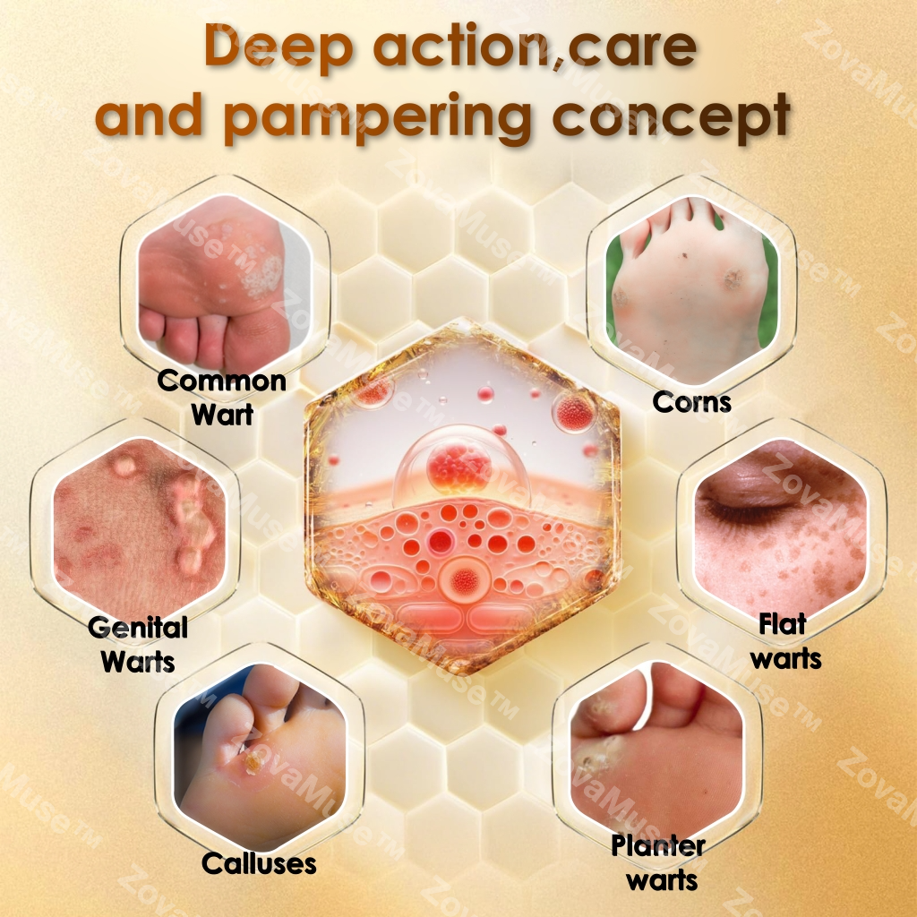 Bee Venom Corn & Callus Remover Cream