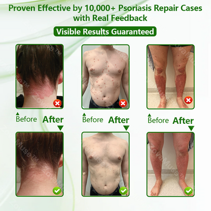 Eczema Relief Cream for Dry, Itchy Skin