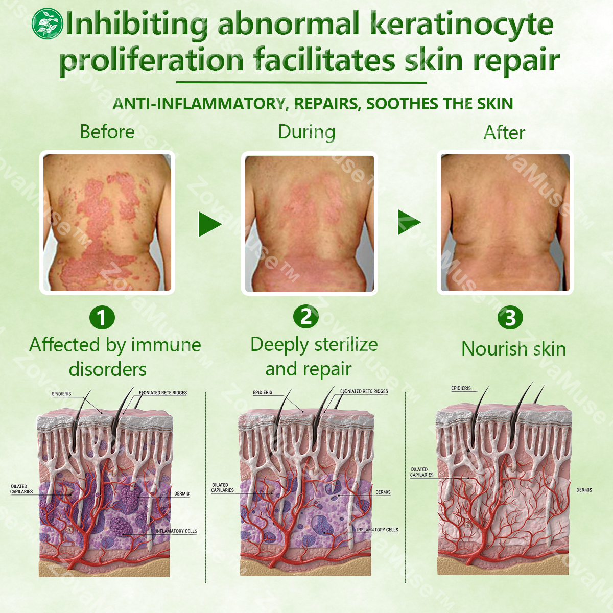 Eczema Relief Cream for Dry, Itchy Skin