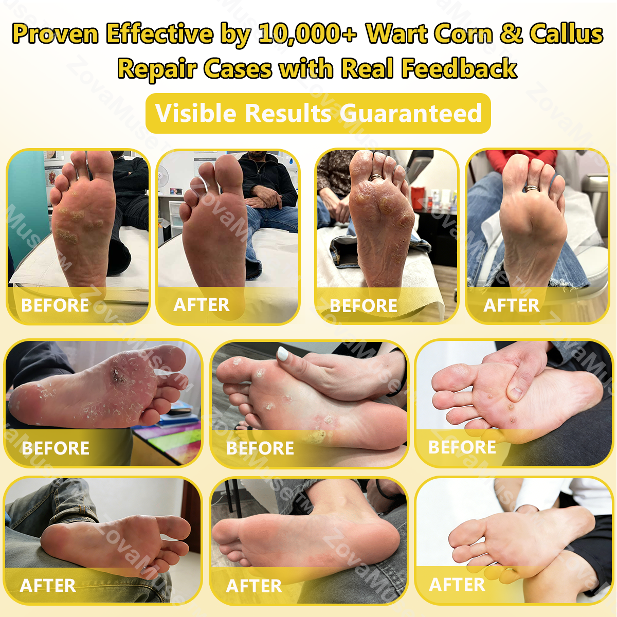 Bee Venom Corn & Callus Remover Cream