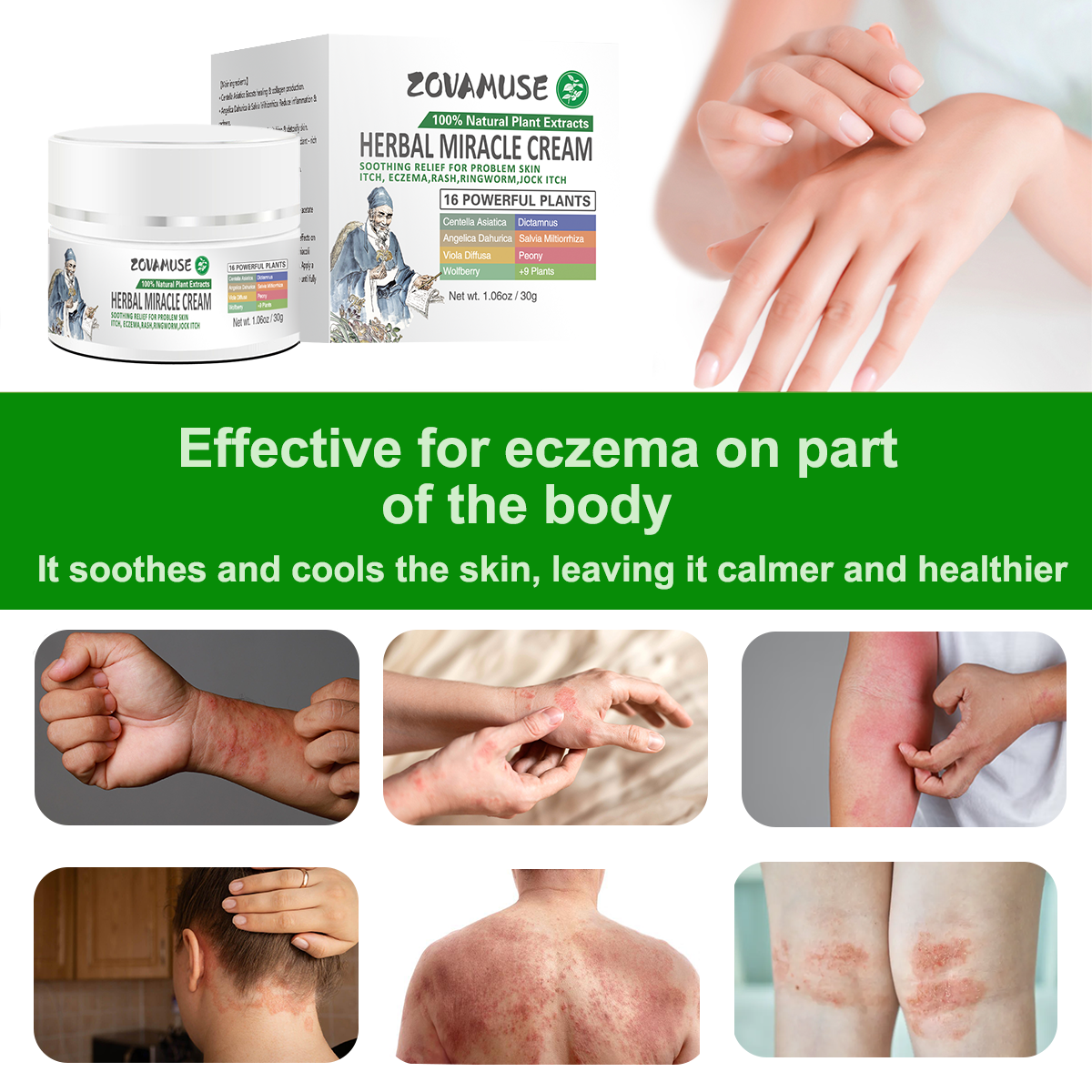 Herbal Miracle Cream for Stubborn Eczema