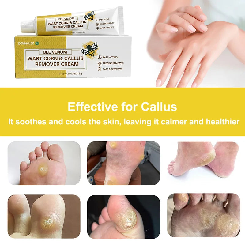 Callus Softening Cream for Dry, Cracked Skin