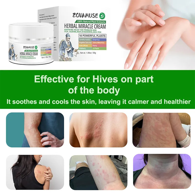 Hives Relief Cream for Itchy, Raised Skin