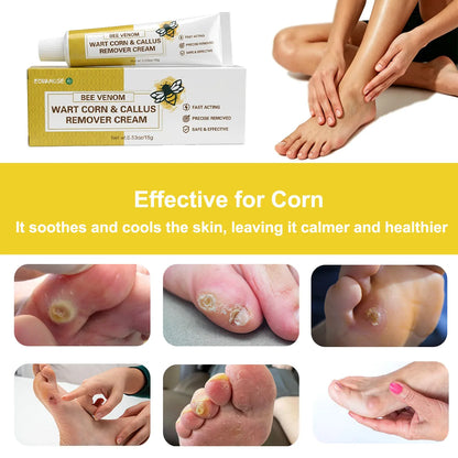 Corn Softening Cream for Thick, Hardened Skin