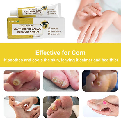Corn Softening Cream for Thick, Hardened Skin