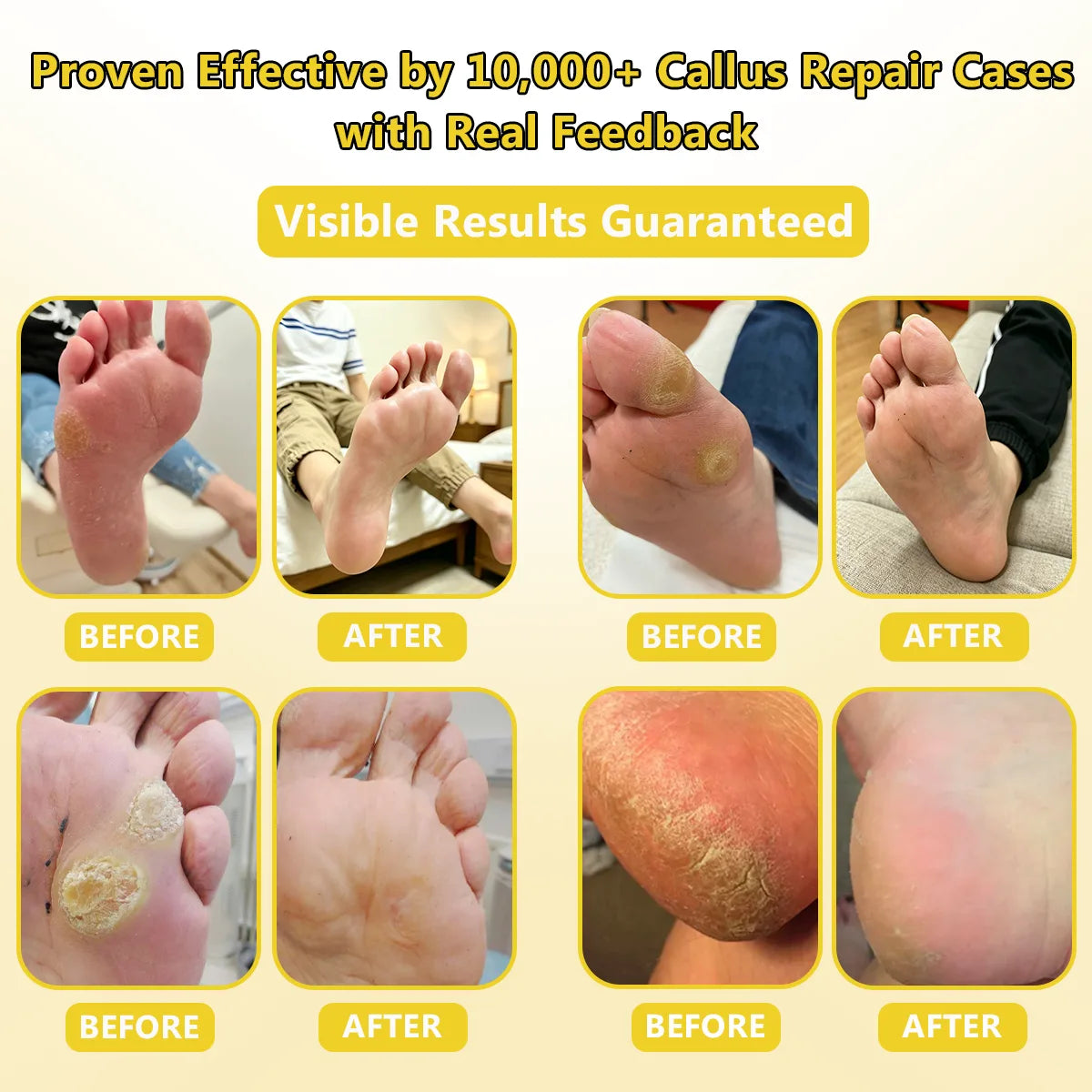 Callus Softening Cream for Dry, Cracked Skin