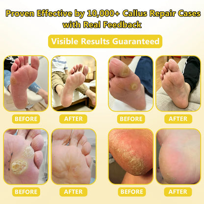 Callus Softening Cream for Dry, Cracked Skin