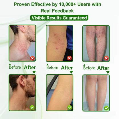 Eczema Relief Cream for Dry, Itchy Skin