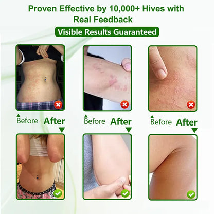 Hives Relief Cream for Itchy, Raised Skin