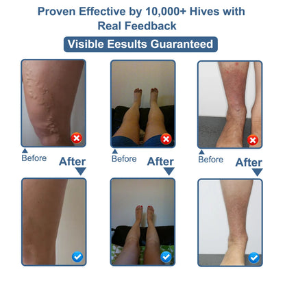 Vein Revive Cream for Heavy Legs and Spider Veins
