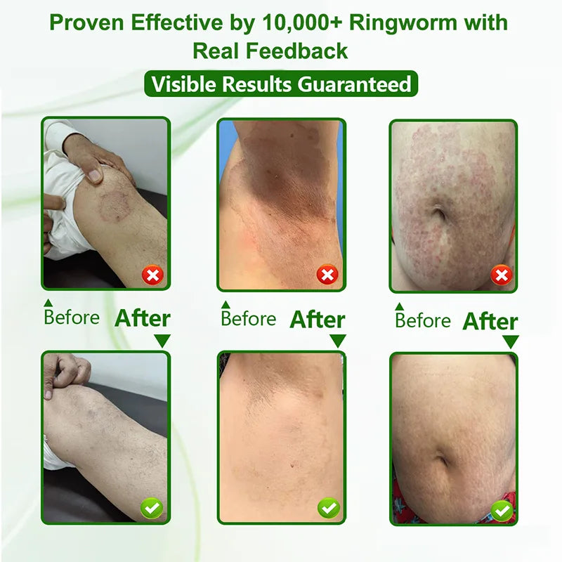 Ringworm Relief Cream for Itchy, Irritated Skin