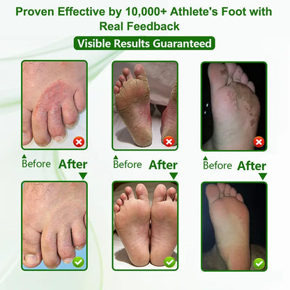 Athlete's Foot Relief Cream for Itchy, Burning Skin