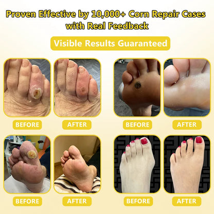 Corn Softening Cream for Thick, Hardened Skin