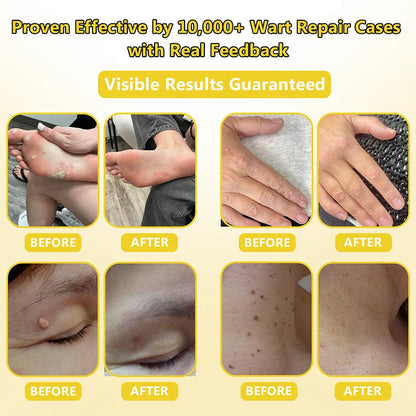 Wart Smoothing Cream for Rough, Thickened Skin
