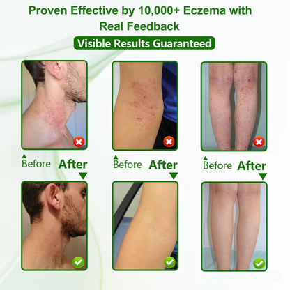 Herbal Miracle Cream for Stubborn Eczema